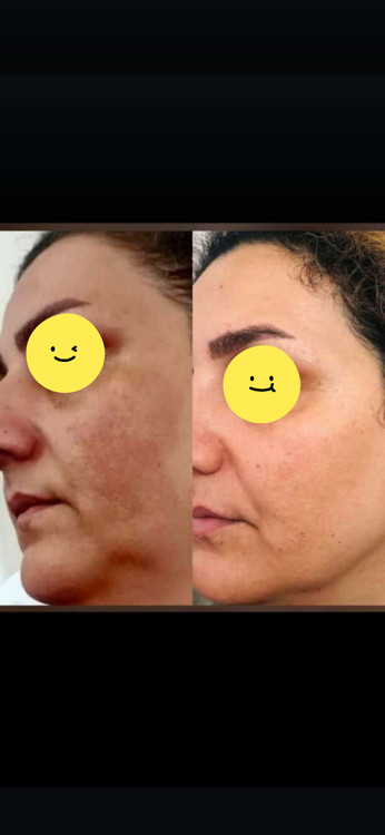 قبل و بعد با محصولات انار